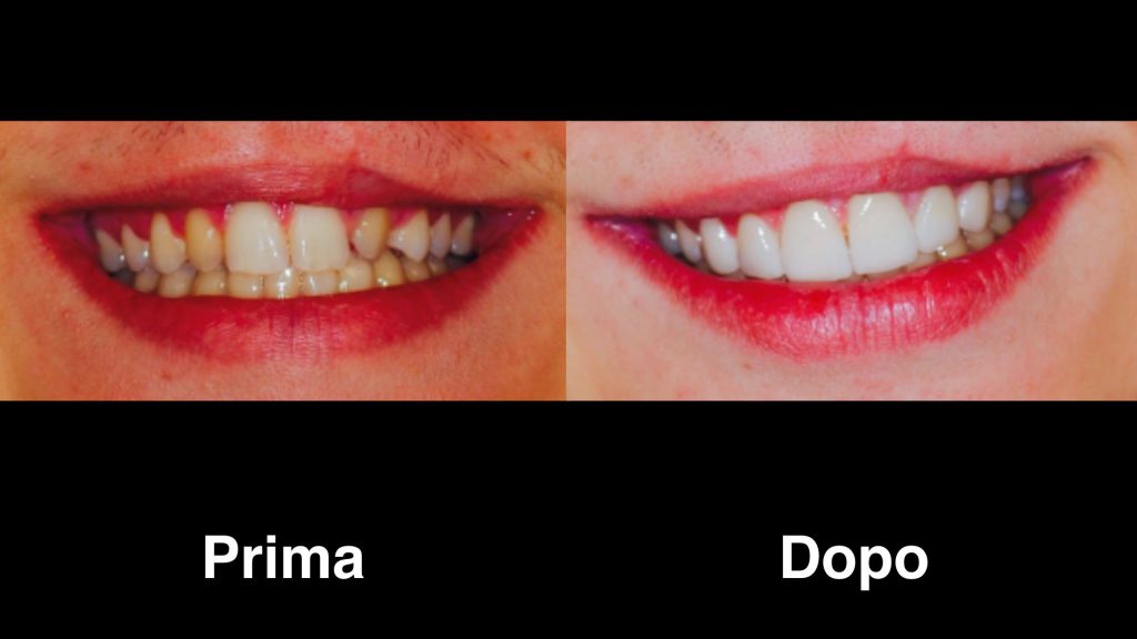 Faccette Dentali, migliora l'aspetto estetico del tuo Sorriso